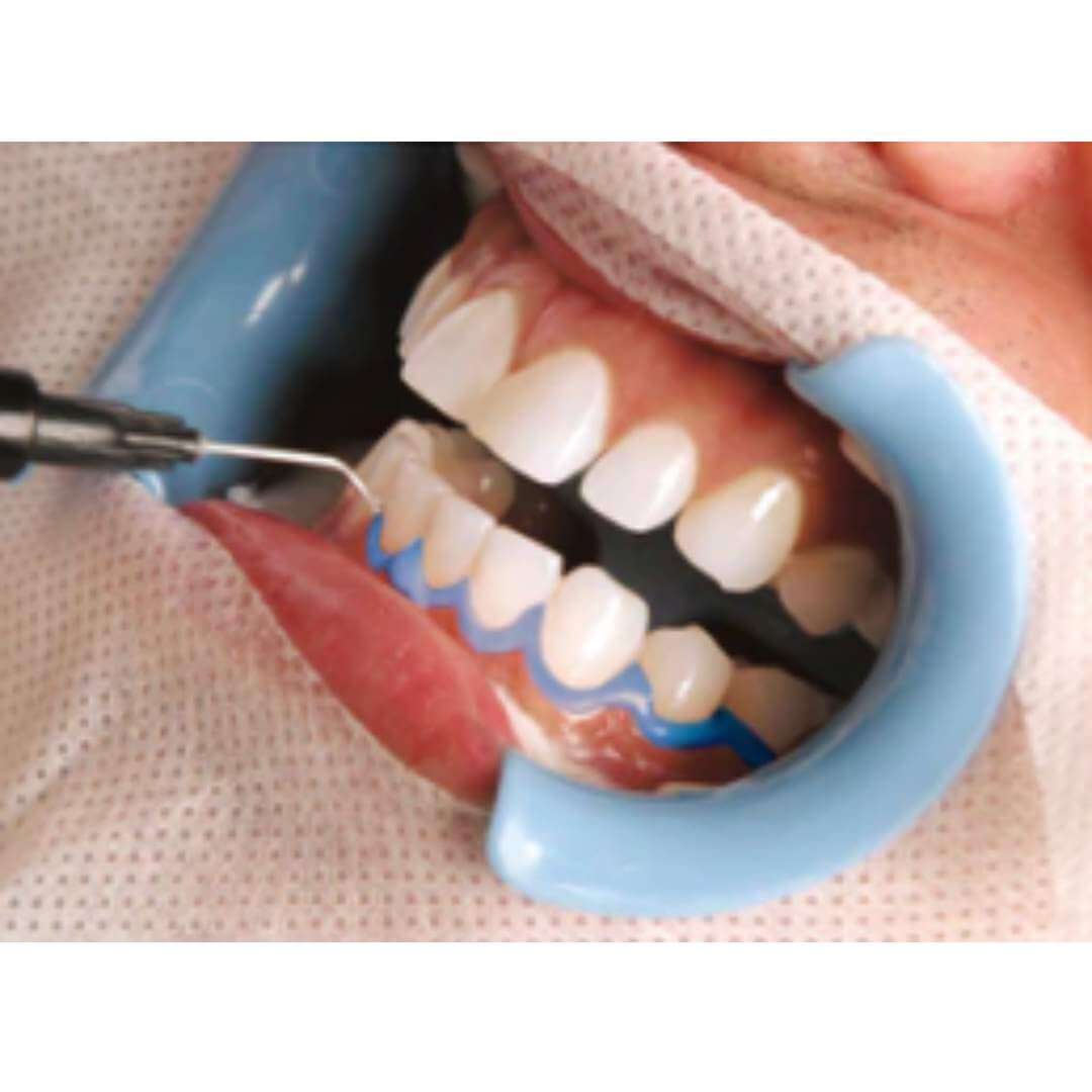 Beyond BlueSeal gingival barrier protection (5 syringe pack)