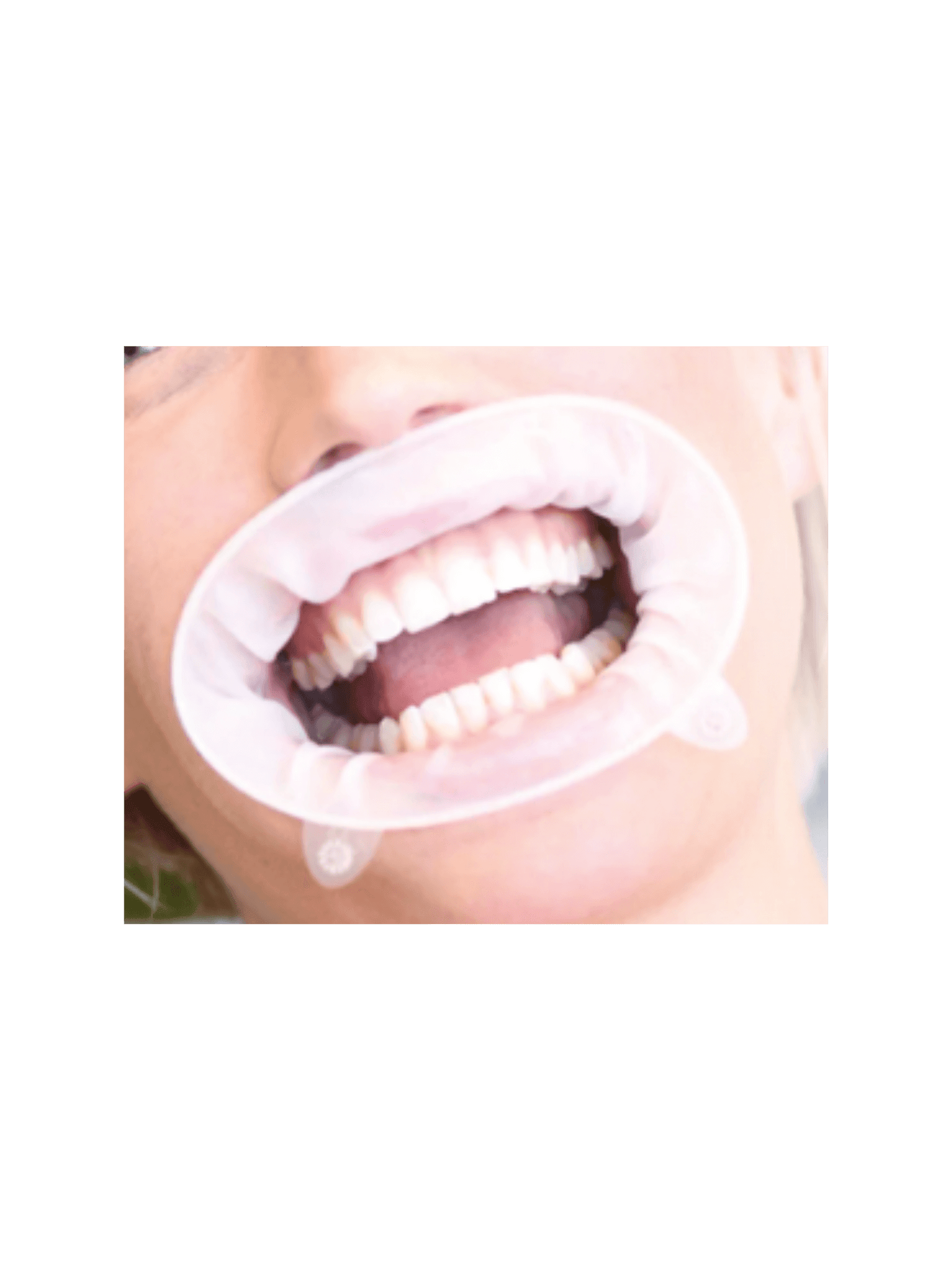 Optragate | Latex-Free Lip and Cheek Retractors