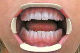 Tri-Dente
